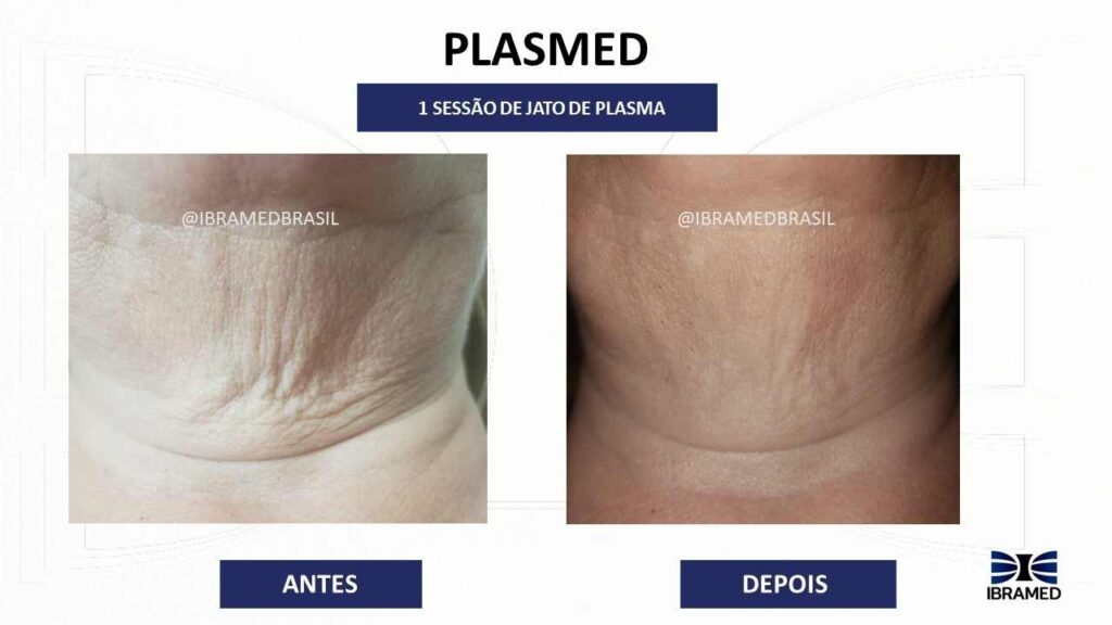 Jato de Plasma para redução de flacidez do pescoço - Antes e depois