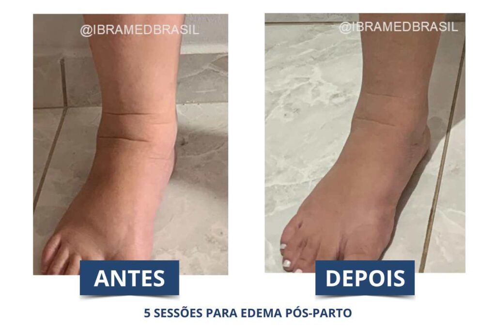 Antes e depois utilizando Pressoterapia para edema pós-parto