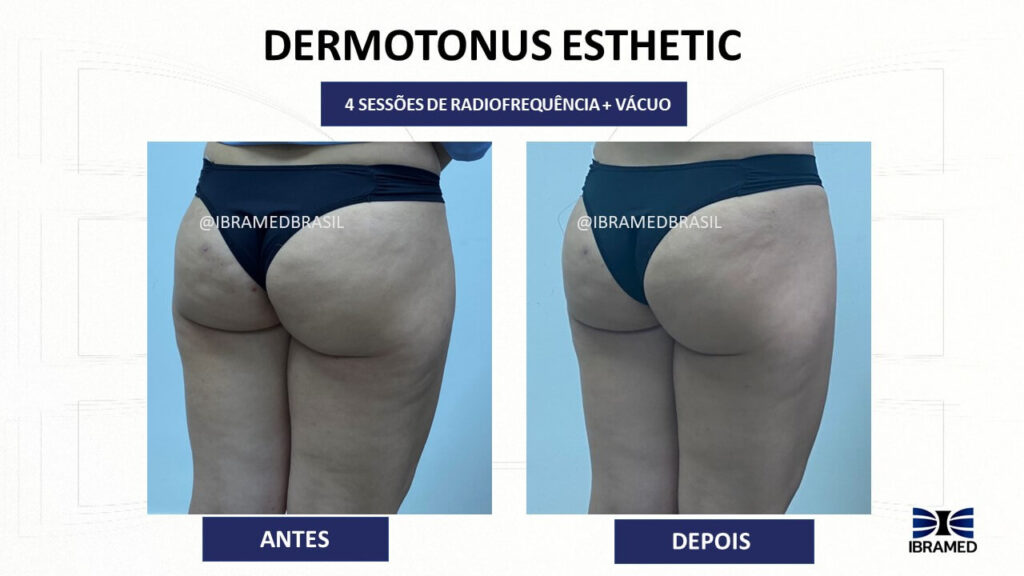Antes e depois no tratamento de Celulite utilizando o Dermotonus Esthetic - Radiofrequência com Vácuo