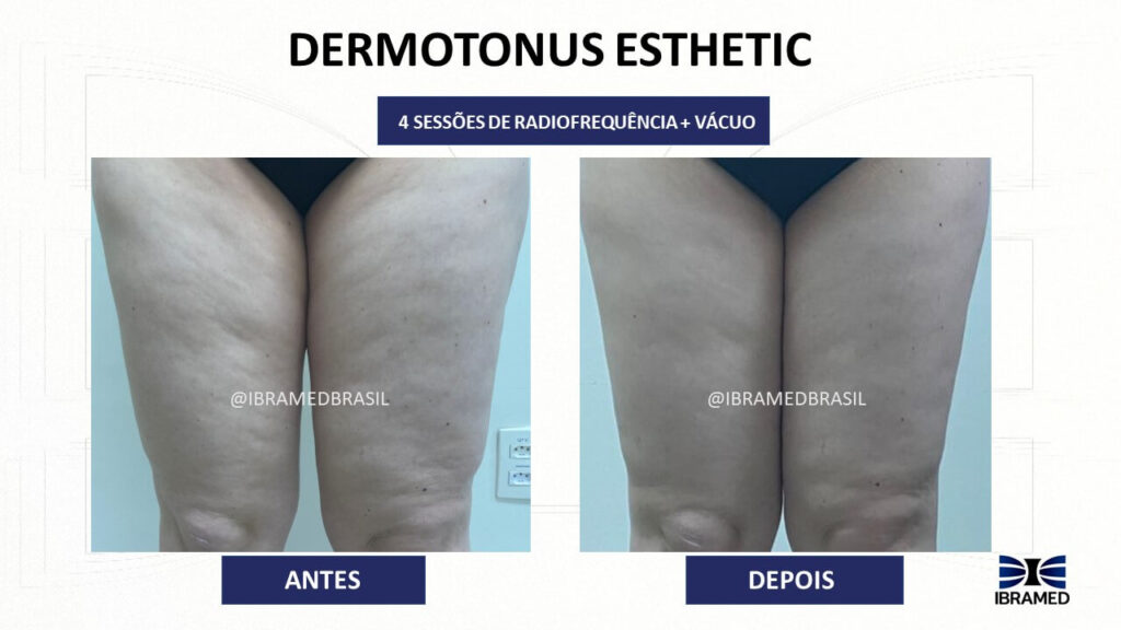 Antes e depois no tratamento de Celulite utilizando o Dermotonus Esthetic - Radiofrequência com Vácuo