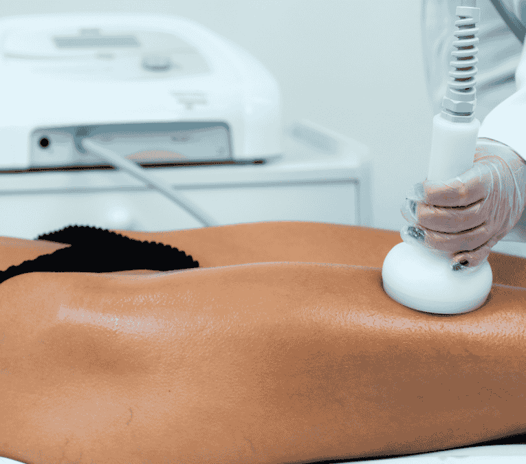 Radiofrequência associada a Vacuoterapia para tratamento de celulite - Dermotonus Esthetic