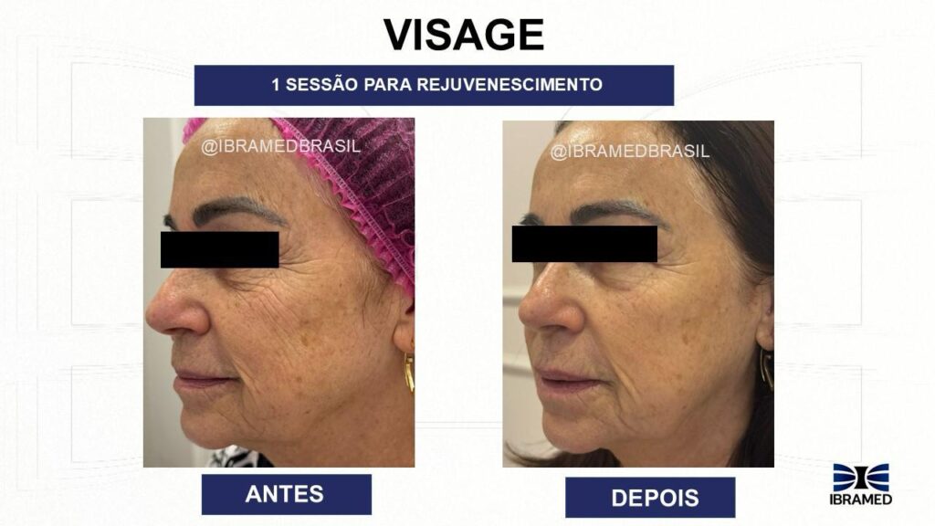 Ultrassom Microfocado Visage no Rejuvenescimento Facial