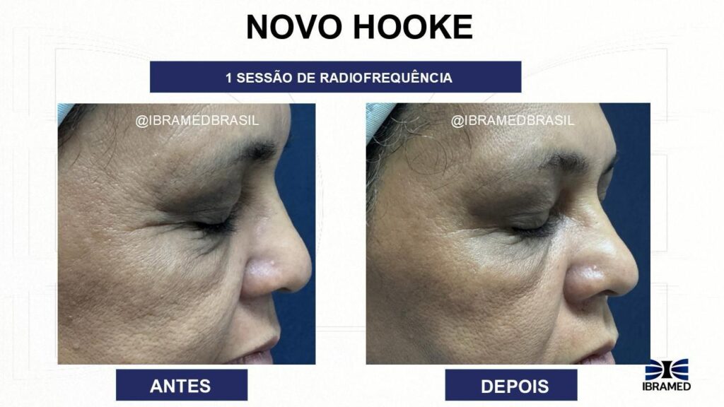 Hooke Antes e Depois - Radiofrequência 27,12Mhz