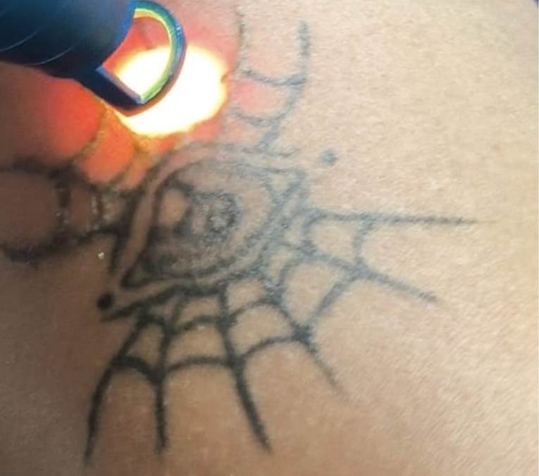 Remoção de Tatuagem com Laser Nd:Yag Q-Switched Syrius Yag Ibramed