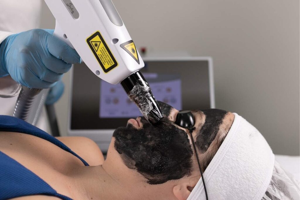 Blackpeel com o Syrius Yag da Ibramed