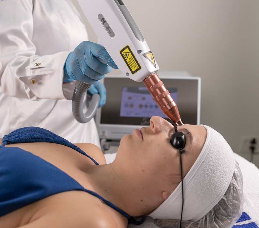 Remoção de micropigmentação com Laser Nd:Yag Q-switched Syrius Yag