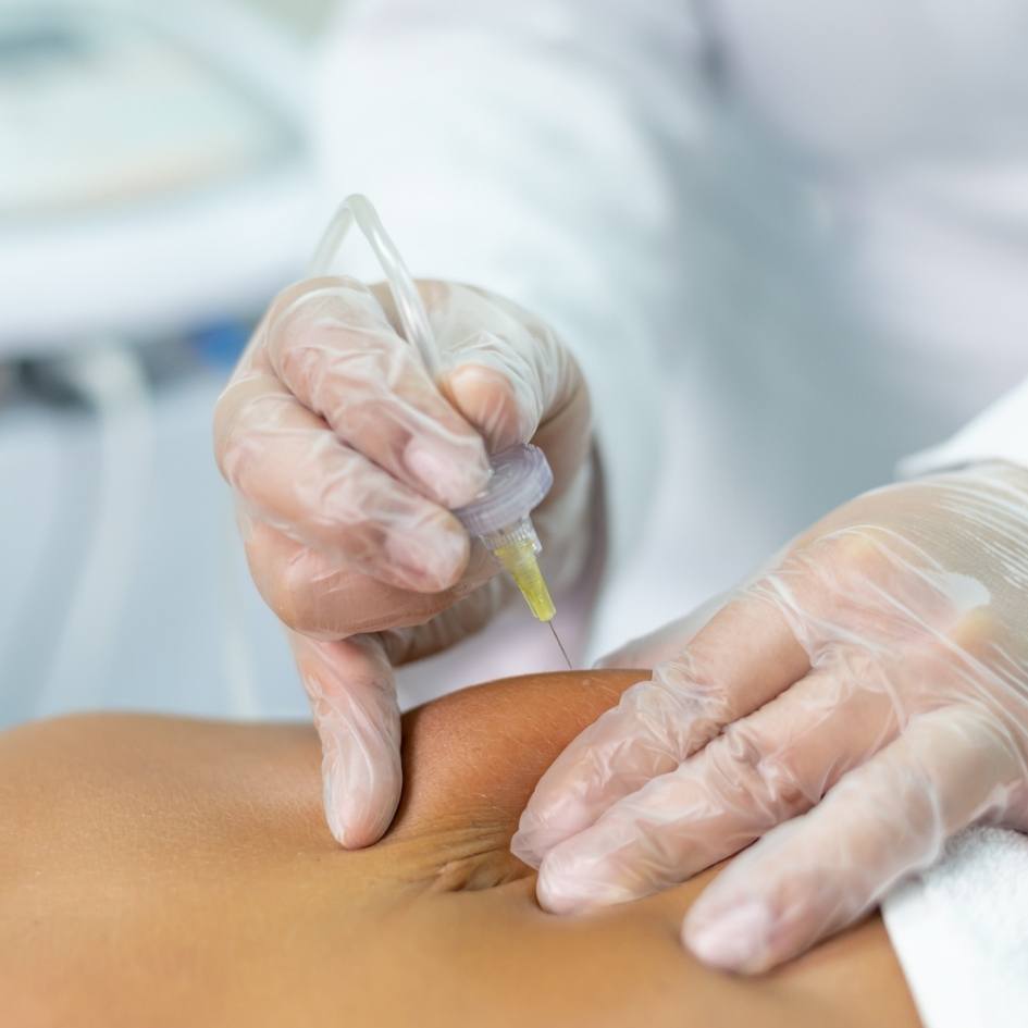 Ares carboxiterapia da IBRAMED - Tratamento para gordura localizada