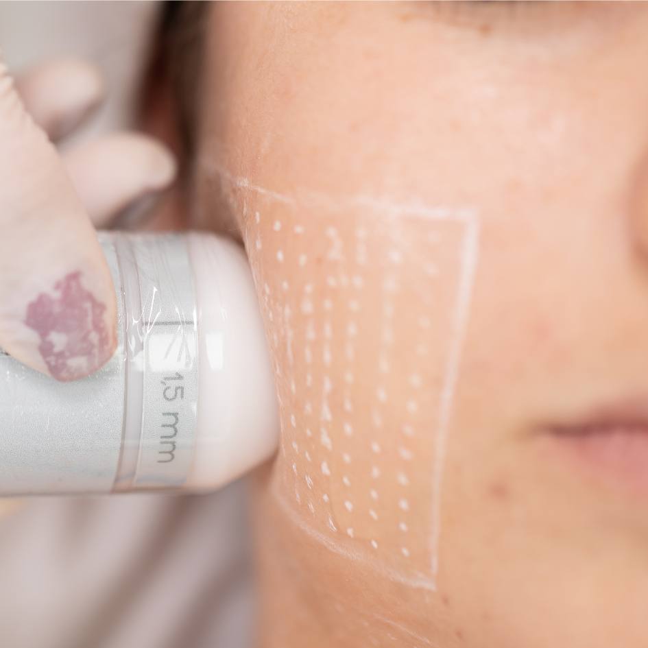 Ultrassom Microfocado - Tendência na área estética 2025 - Guia completo de Ultrassom Microfocado hifu