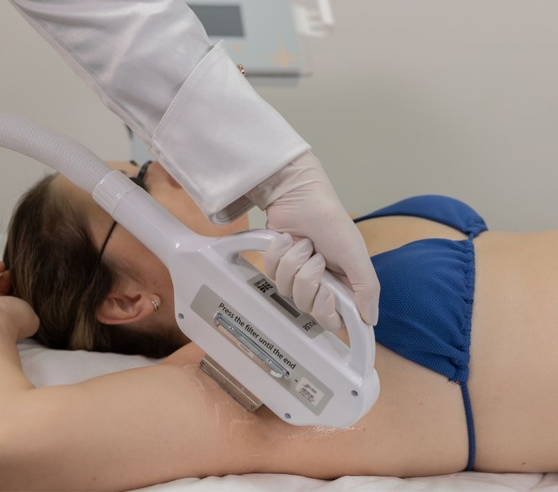 Luz Intensa Pulsada epilação