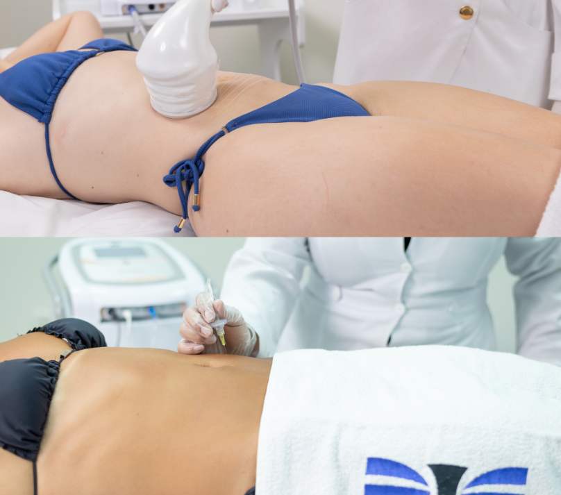 Terapia Combinada: Ultrassom Macrofocado + Carboxiterapia