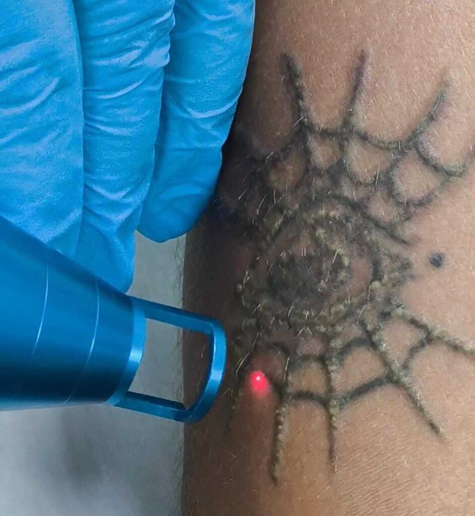 Remoção de Tatuagem com Laser Nd:Yag Q-Switched Syrius Yag Ibramed